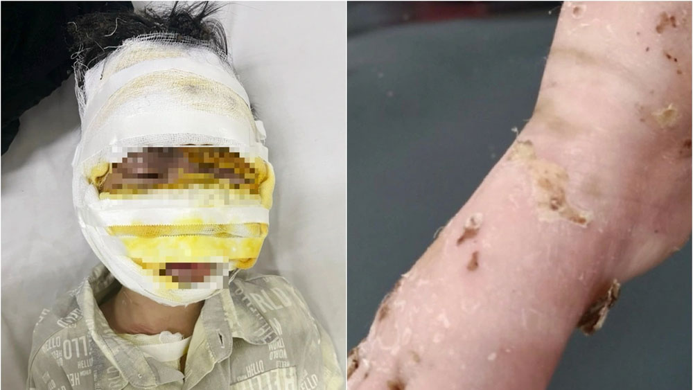 Laptop phát nổ, bé 8 tuổi ở Lục Ngạn bị bỏng nặng
